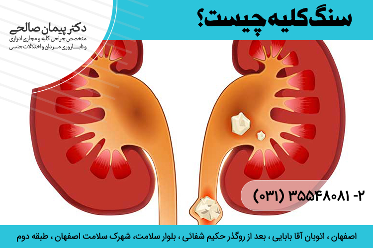 بهترین درمان سنگ کلیه در اصفهان