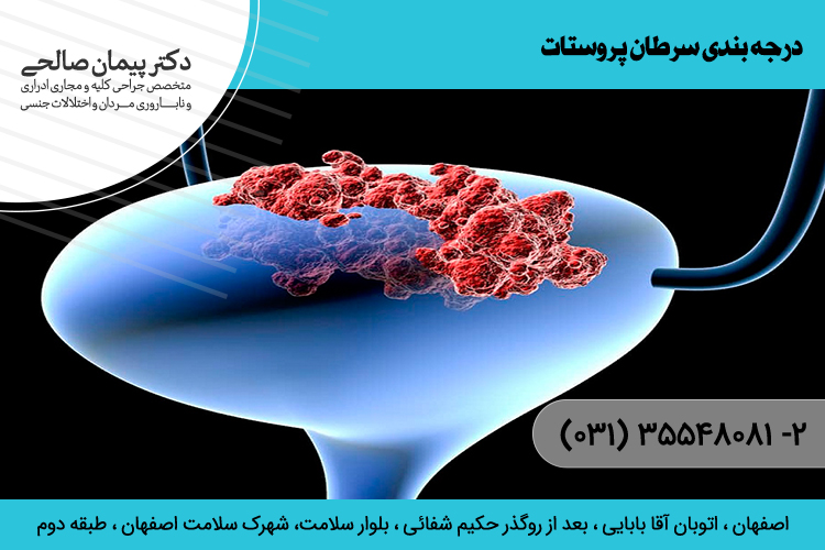 درمان سرطان پروستات در اصفهان