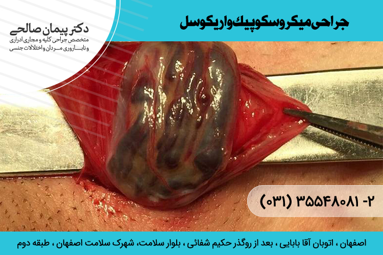 بهترین جراحی میکروسکوپیک واریکوسل در اصفهان