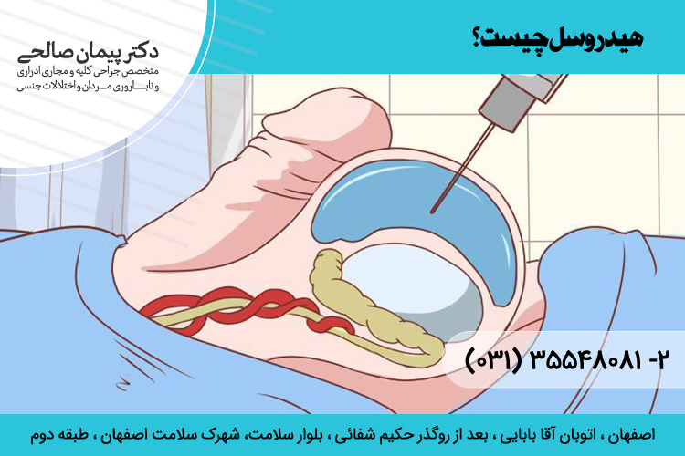 بهترین درمان و جراحی هیدروسل در اصفهان