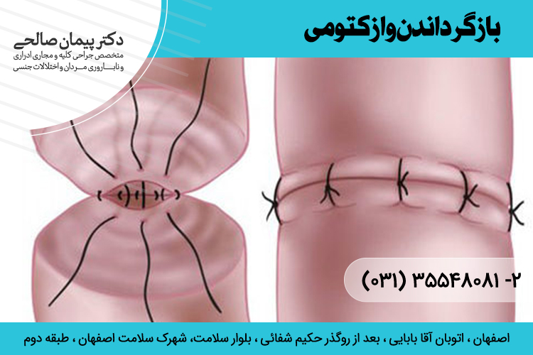  بازگرداندن وازکتومی در اصفهان