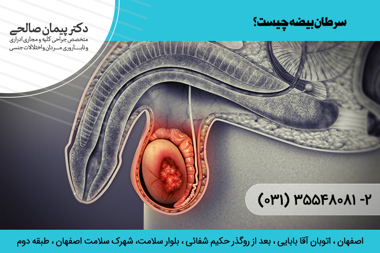 بهترین درمان سرطان بیضه در اصفهان