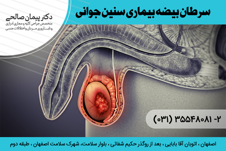 بهترین درمان سرطان بیضه در اصفهان