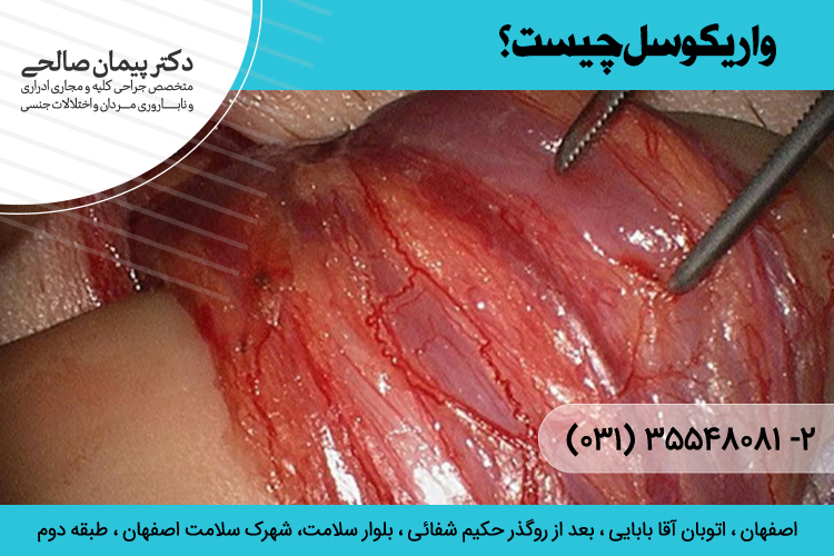 درمان واریس بیضه در اصفهان