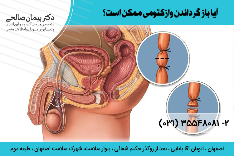 عمل باز گرداندن وازکتومی  چگونه است؟