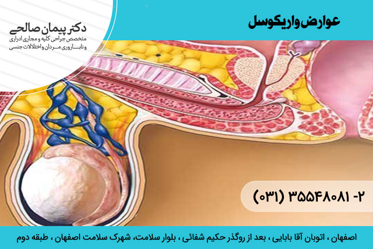 عوارض واریکوسل و درمان آن ، دکتر پیمان صالحی