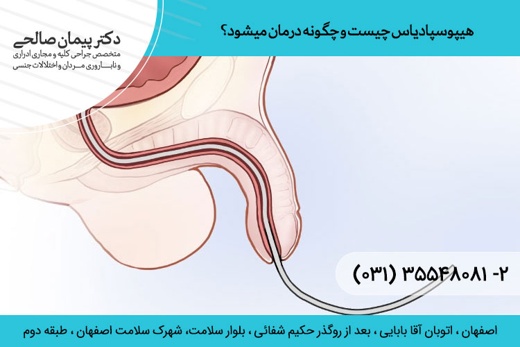 علت و درمان هیپوسپادیاس