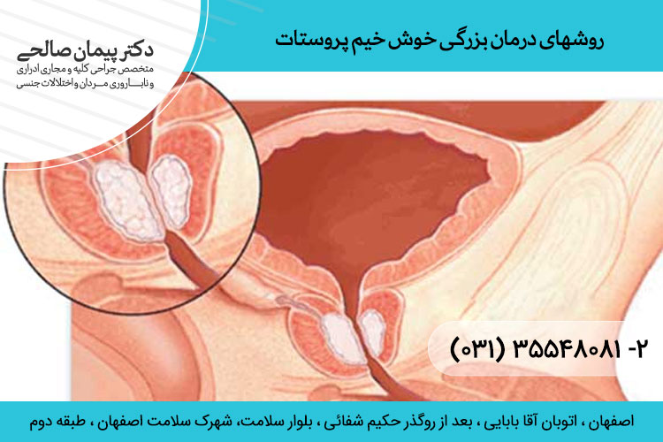 درمان بزرگی خوش خیم پروستات