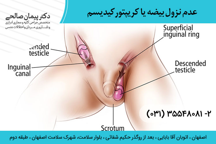 علت عدم نزول بیضه