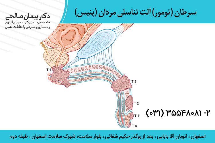 سرطان آلت تناسلی