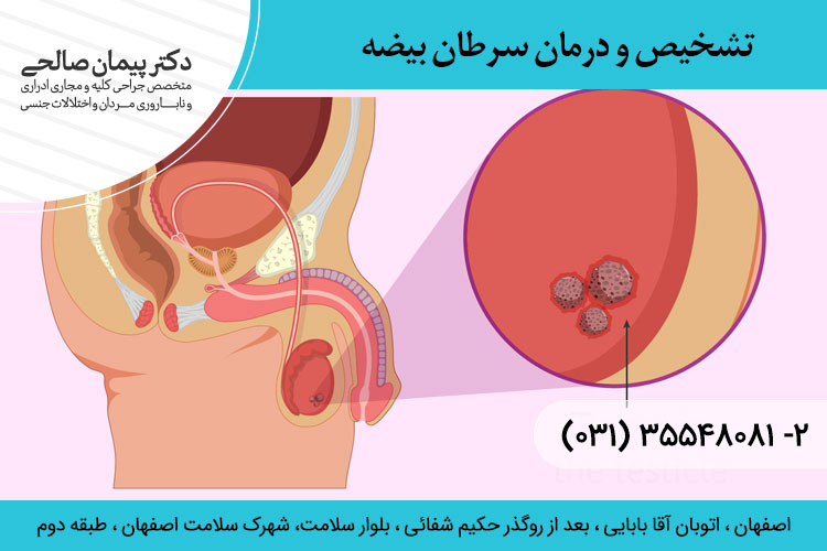 تشخیص و درمان سرطان بیضه