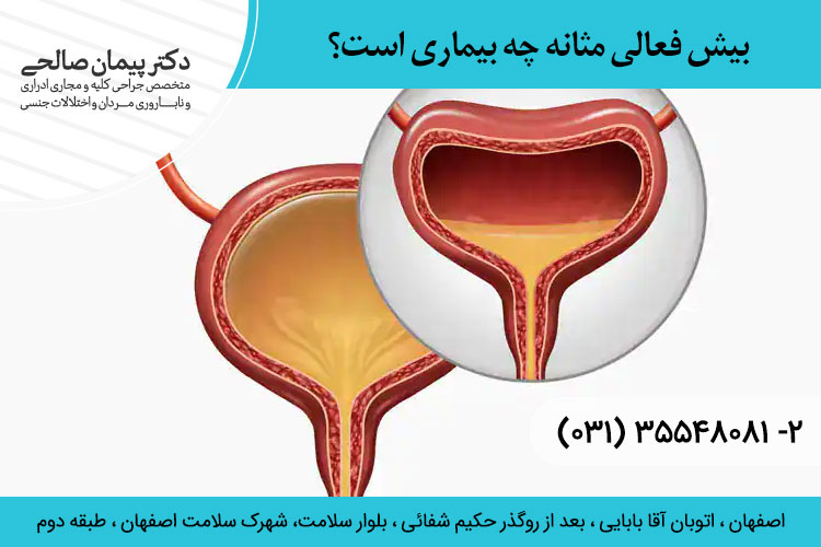 بیش فعالی مثانه