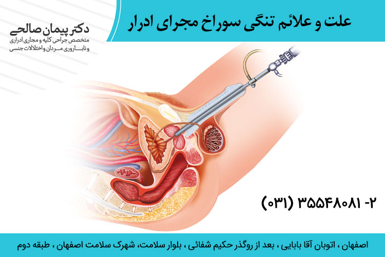 تنگی سوراخ مجرای ادرار