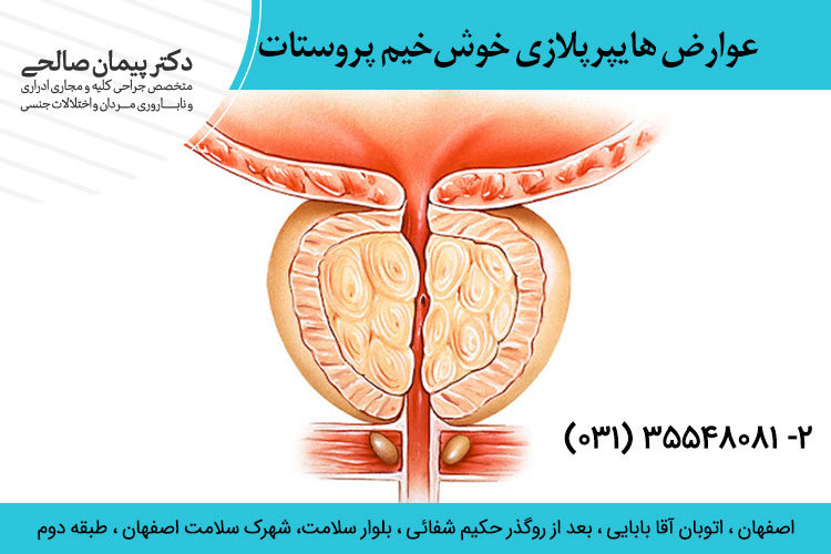 بزرگ شدن غده پروستات