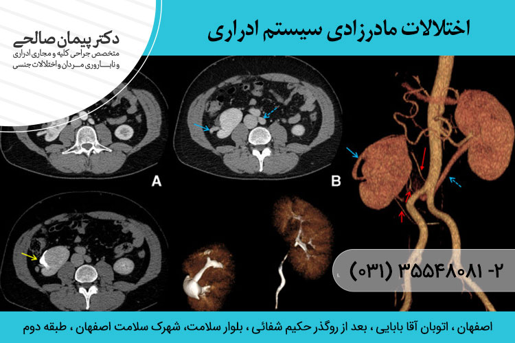 اختلالات مادرزادی سیستم ادراری 