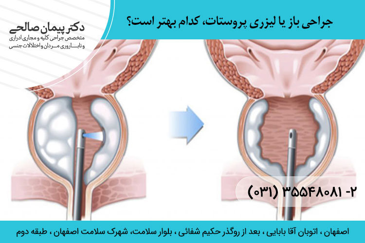 جراحی باز یا لیزری پروستات