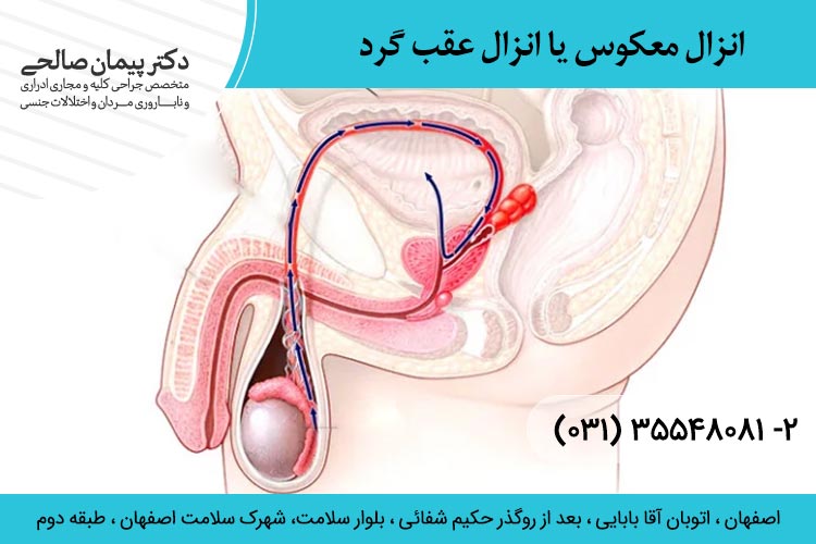 انزال معکوس یا انزال عقب گرد