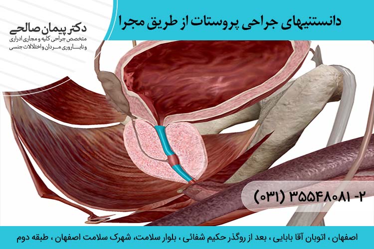  جراحی پروستات از طریق مجرا