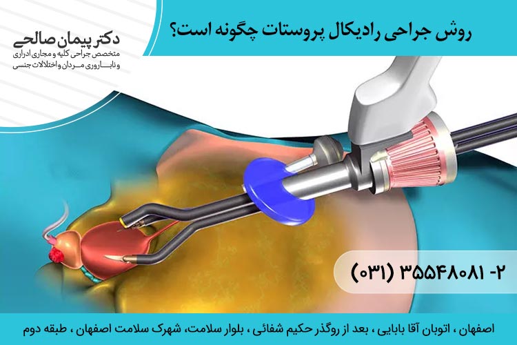 روش جراحی رادیکال پروستات