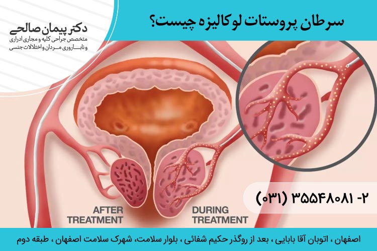 سرطان پروستات لوکالیزه