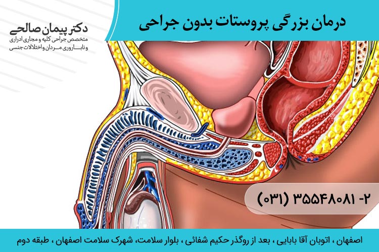 درمان بزرگی پروستات بدون جراحی