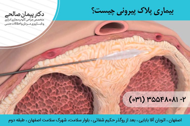 بیماری پلاک پیرونی