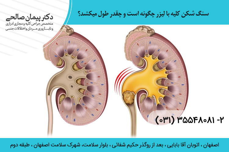 سنگ شکن کلیه با لیزر