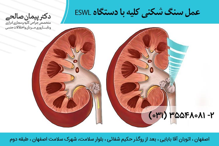 عمل سنگ شکنی کلیه