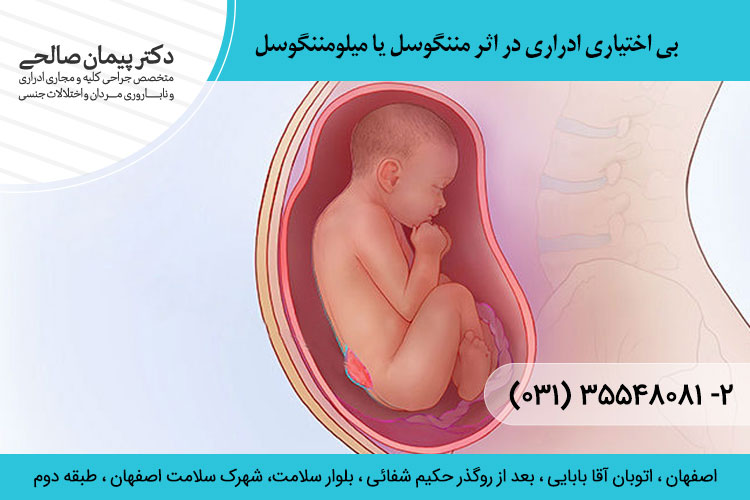 بی اختیاری ادراری در اثر مننگوسل یا میلومننگوسل