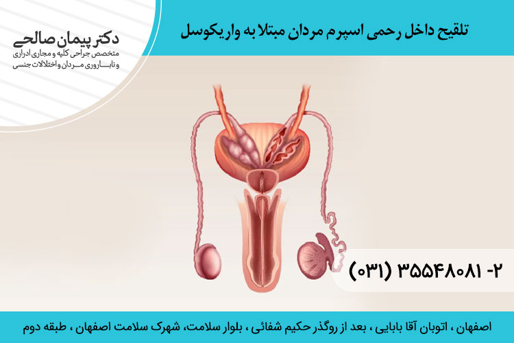 تلقیح داخل رحمی اسپرم مردان مبتلا به واریکوسل