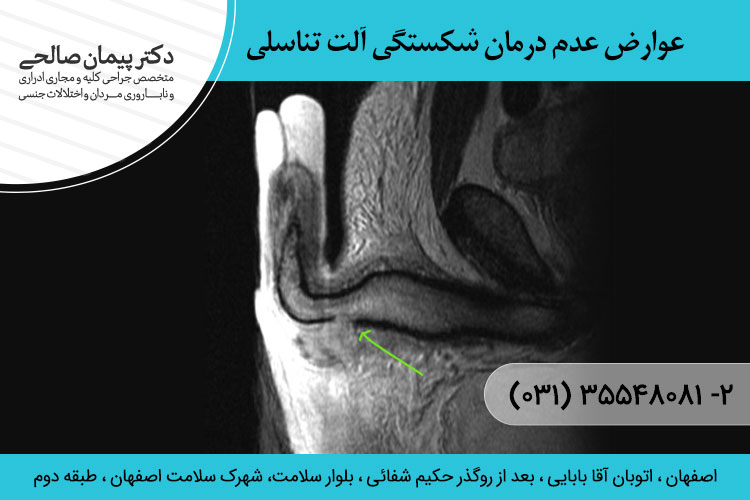 شکستگی آلت تناسلی