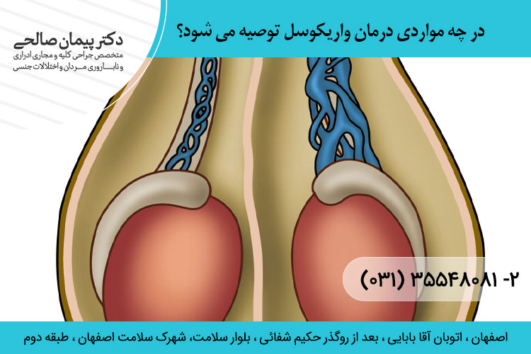 درمان واریکوسل