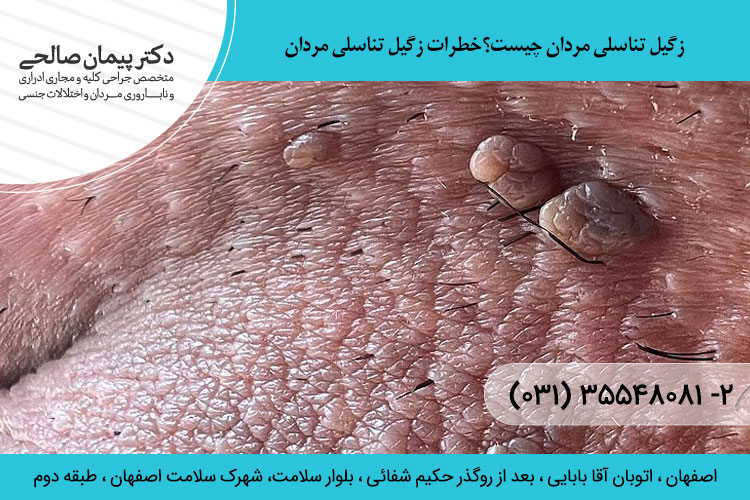 زگیل تناسلی در مردان