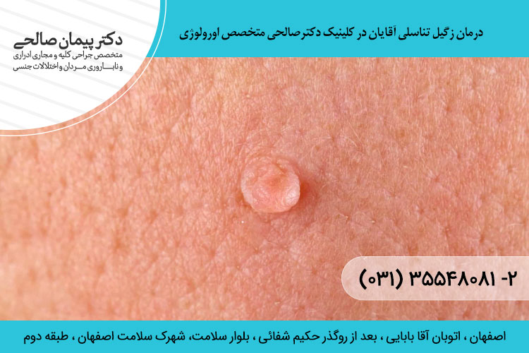 درمان زگیل تناسلی مردان