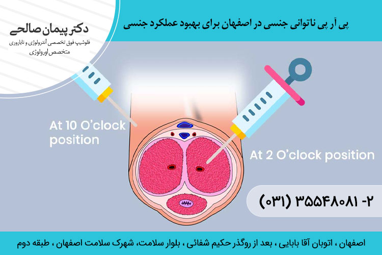 تعداد جلسات و ماندگاری پی آر پی ناتوانی جنسی
