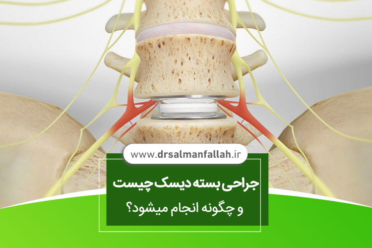 انواع جراحی بسته دیسک