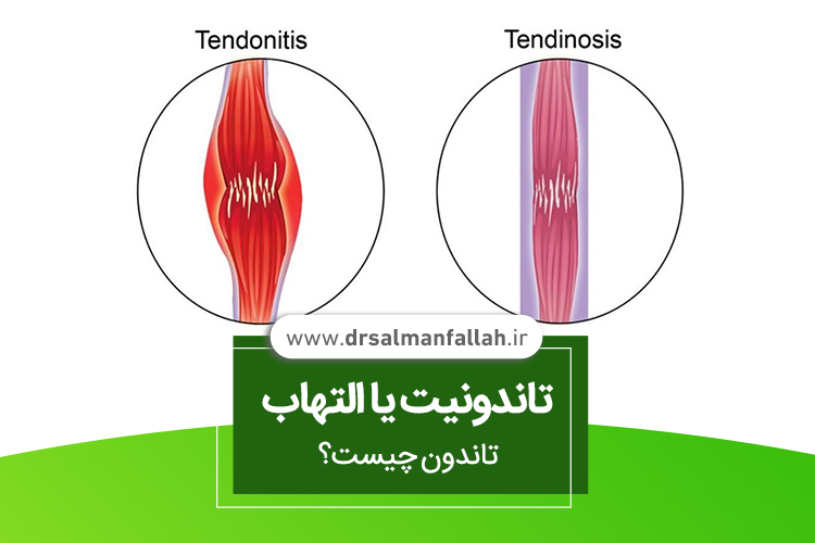 تاندونیت