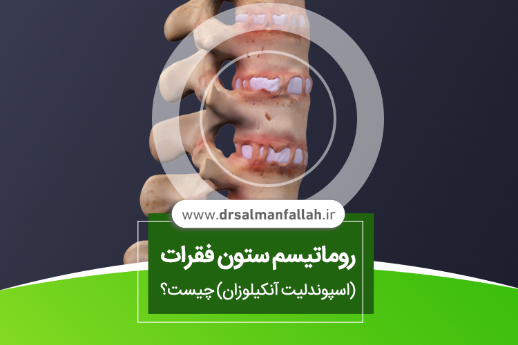 روماتیسم ستون فقرات