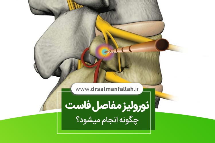 نورولیز مفاصل فاست