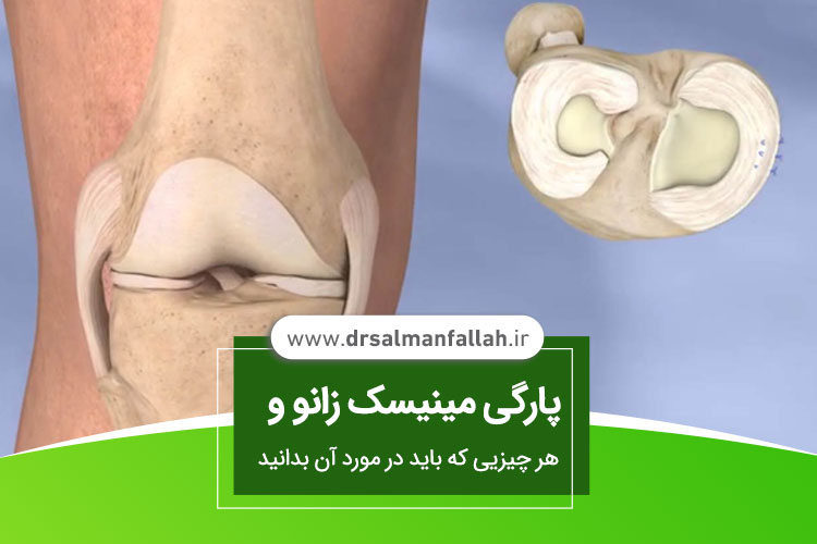 پارگی مینیسک زانو