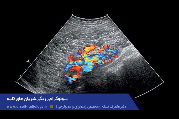 سونوگرافی رنگی شریان های کلیه