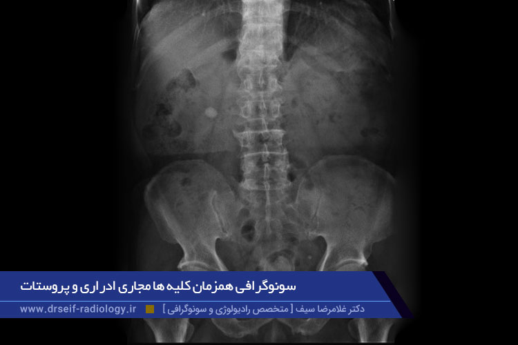 سونوگرافی همزمان کلیه مجاری ادراری و پروستات