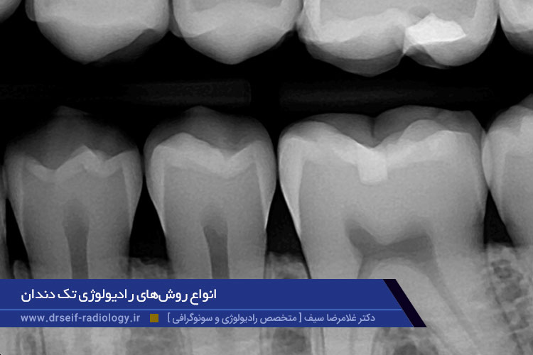 انواع روش‌های رادیولوژی تک دندان
