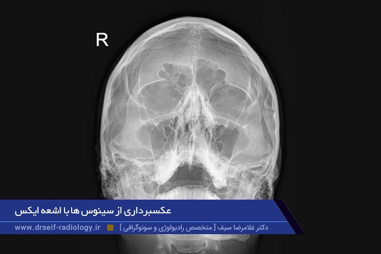 رادیوگرافی اسکولیوزیس