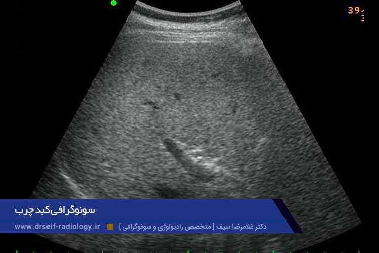 سونوگرافی کبد چرب
