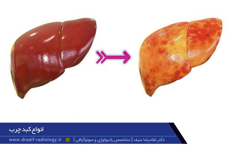 انواع کبد چرب