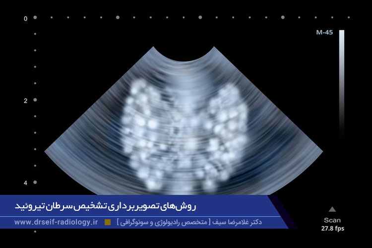 سونوگرافی تیروئید