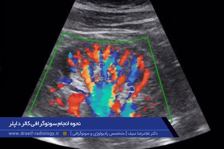 سونوگرافی کالر داپلر شریانی