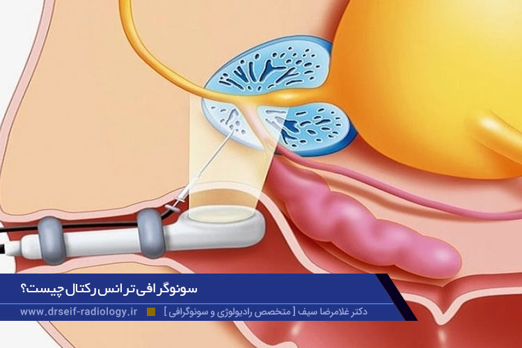 سونوگرافی ترانس رکتال