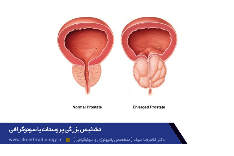 بزرگی پروستات